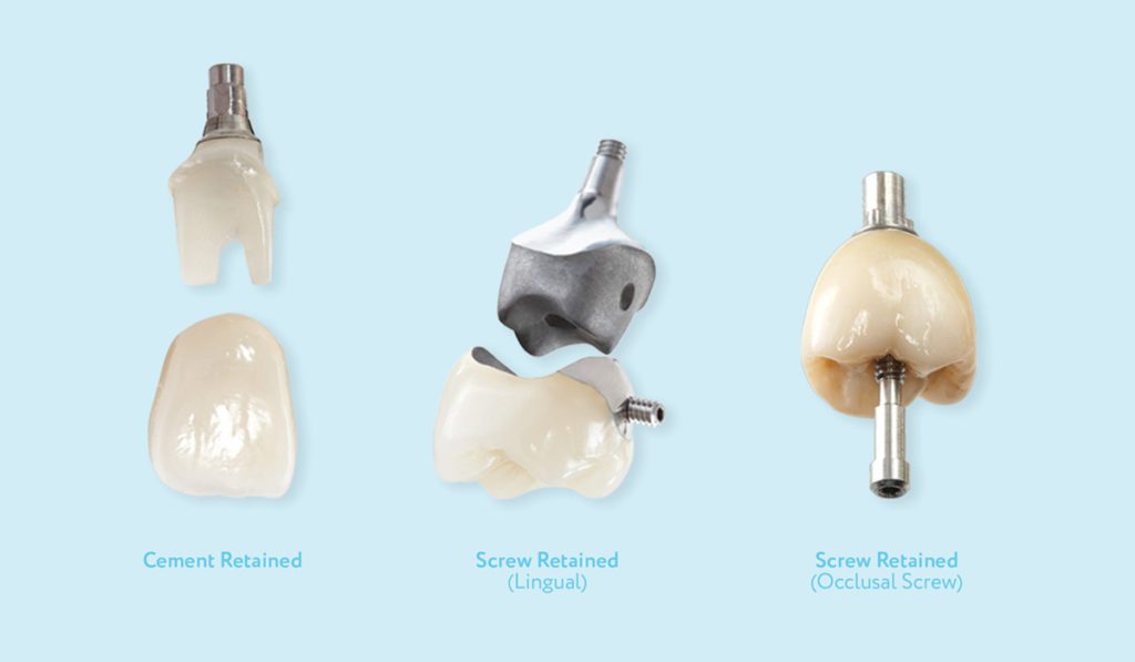 Implant Crowns - Dental Crafters