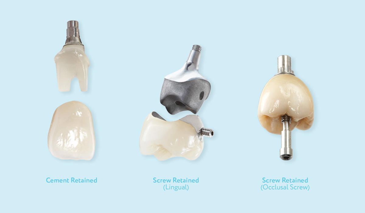 Types Of Crowns For Implants